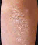 dermatoses et soins dermatoses et soins