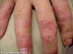 dermatoses et soins dermatoses et soins