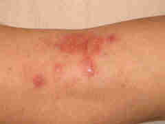 dermatoses et soins dermatoses et soins
