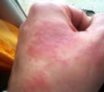 Allergie contact