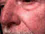 dermatoses et soins dermatoses et soins