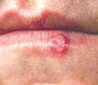 Herpes labial - Traitement de l’herpes