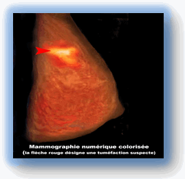 Mammographie - Le cancer du sein
