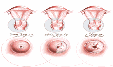 Cancer du col - Le cancer du col de l&#039;utérus