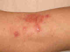 Eczema atopique - Le Psoriasis