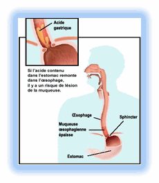 REFLUX GASTRO-ŒSOPHAGIEN