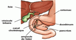 Vesicule biliaire - Cholécystite aiguë