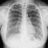 Symptomes cancer du poumon
