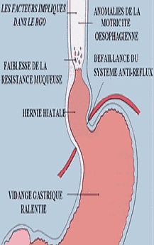 REFLUX GASTRO-ŒSOPHAGIEN
