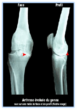 arthrose