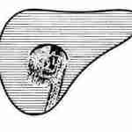 Kyste Hydatique 150x150 - Exploration radiologique du foie et de la rate : les lésions focales