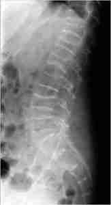 L'ostéoporose : Le diagnostic radiographique d'une fracture vertébrale