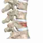 L'ostéoporose : Les fractures des membres