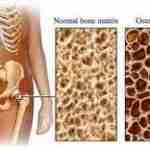 Goutte, ostéoporose et ostéomalacie