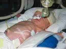 Les détresses respiratoires néonatales d'origine malformative