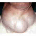 Les dysfonctionnements de la thyroïde : les nodules thyroïdiens