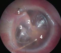 150 - Atteintes de l&#039;oreille moyenne:Rétraction de la membrane tympanique