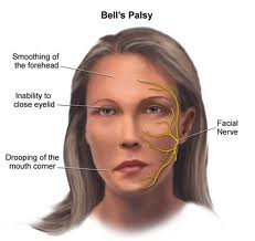 165 - Atteintes du nerf facial:Infection et paralysie faciale