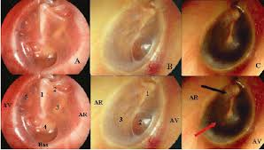 248 - Atteintes de l&#039;oreille moyenne:Rétraction de la membrane tympanique