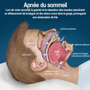 apnée