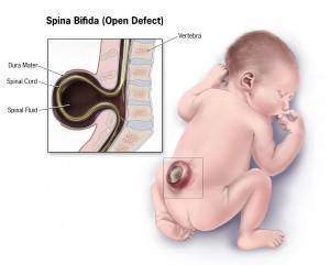 spina bifida