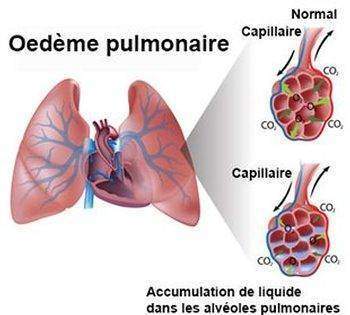 Œdeme-pulmonaire-œdeme-aigu-du-poumon-œdeme-aigu-pulmonaire-ou-eau-dans-les-poumons