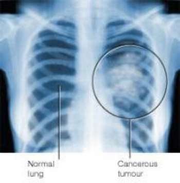 Cancer-des-poumon