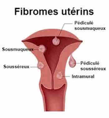 Fibrome et grossesse - Fibrome et grossesse