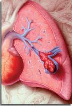 L-embolie-pulmonaire