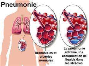 Pneumonie-traitement
