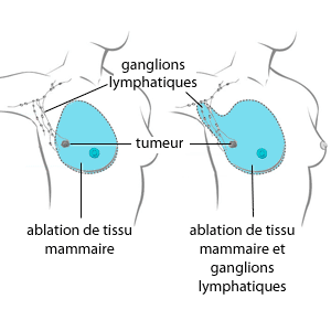 Récidive cancer du sein