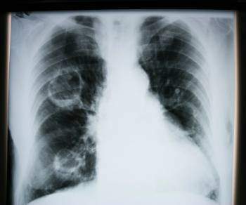 Symptome cancer du poumon - Symptome cancer du poumon