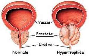 cancer prostate : symptômes