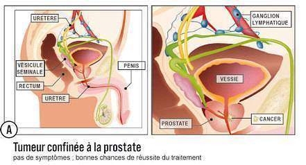 Symptomes-de-la-prostate