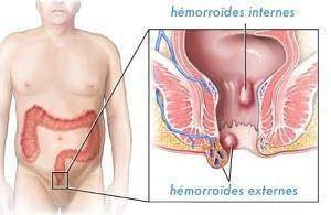 Symptomes hemorroïdes - Symptomes hémorroïdes