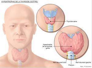 chirurgie-endocrinienne-goitre