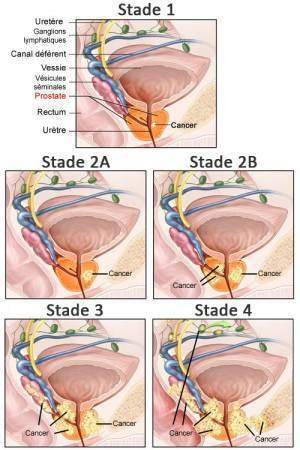 stades-cancer-prostate