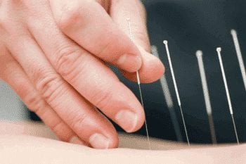 Les indications de l'acupuncture