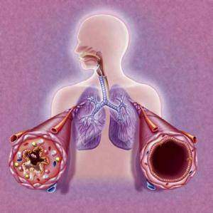 Asthme-Les-mecanismes-associes