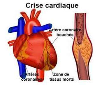 Prévenir l’infarctus du myocarde