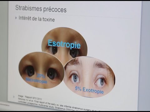 Le strabisme chez l'enfant