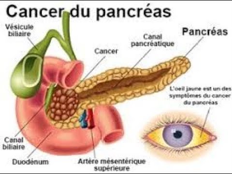 PATHOLOGIE INFLAMMATOIRE ET TUMORALE DU PANCREAS